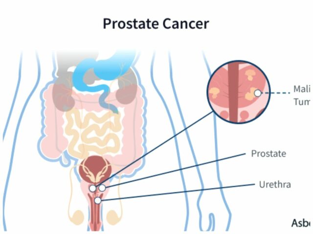 Scientist recommends yearly prostate cancer screening for men above 40