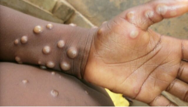 WHO approves first mpox diagnostic test for emergency use