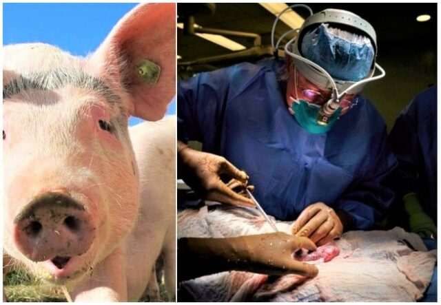 US woman becomes third recipient of gene-edited pig kidney