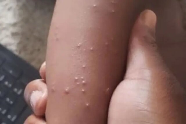 Scabies infects 150 in Adamawa