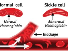 Sickle Cell Challenges — By Livy-Elcon Emereonye 100 sickle cell patients get free NHIA enrolment